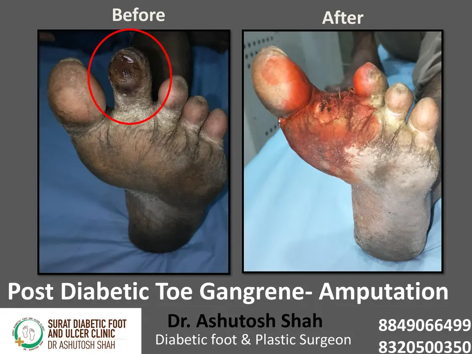 Diabetic Foot  PPT 3 checked by sir.pptx-34.webp